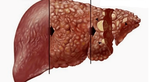 efectos nocivos do alcol no fígado humano